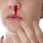 Một người ngồi xử lý chảy máu mũi bằng khăn giấy.